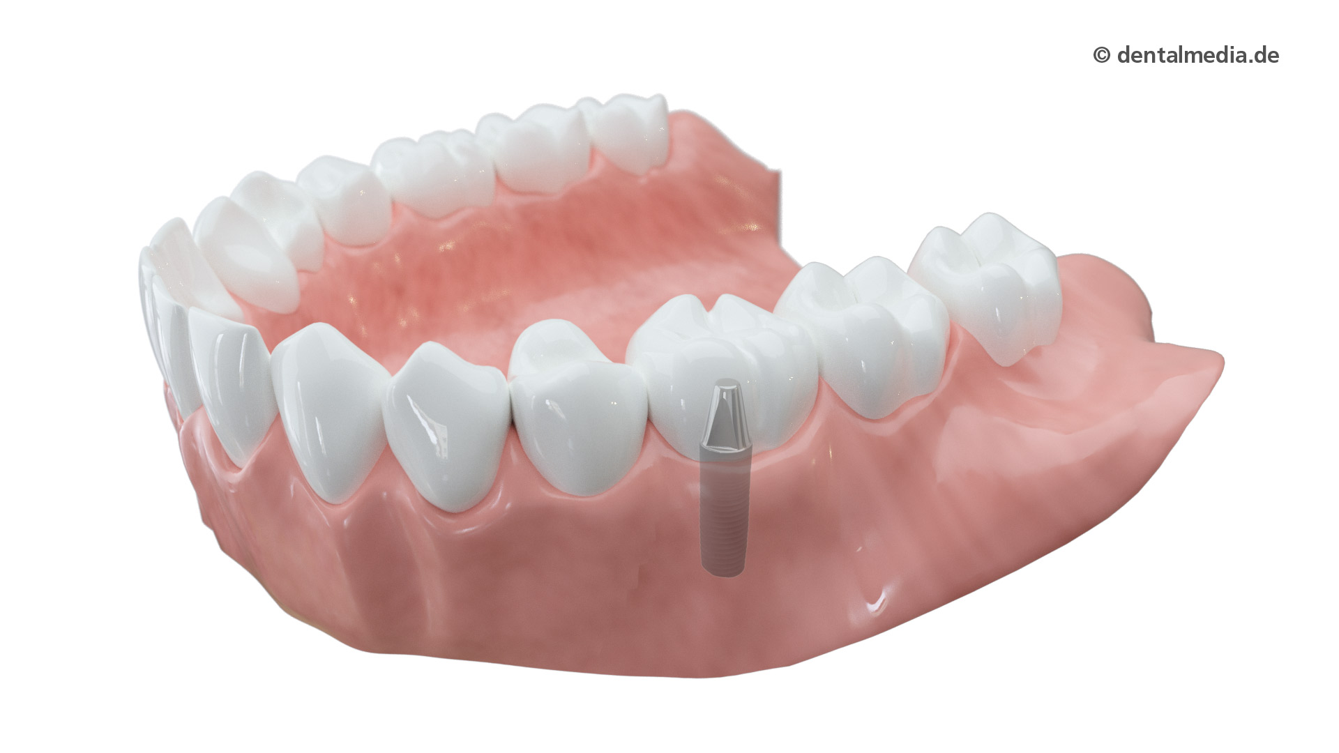 Ein Zahn fehlt. Ein Implantat hat gegenüber einer Brücke den Vorteil, dass Nachbarzähne nicht beschliffen werden müssen.